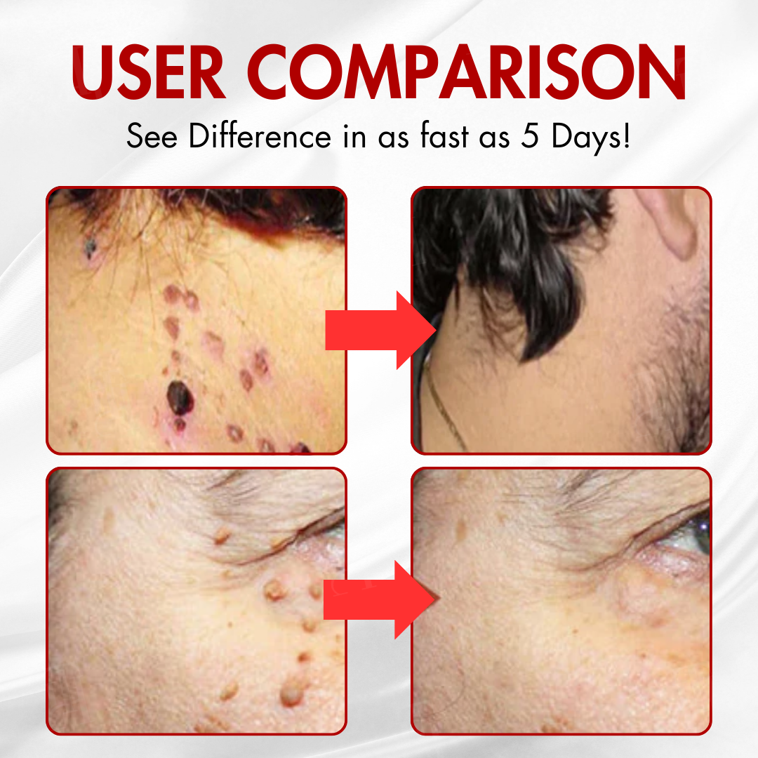 🩹 AEXZR® Nano-Microdart Skin Tag Patches — Painless Removal in 3-7 Days, Dual-Action Repair, No Scarring