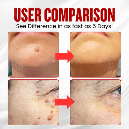 🏆 WartAway Pro — Advanced Microneedle Patches for Painless Wart & Skin Tag Removal – Results in 5 Days! ✨