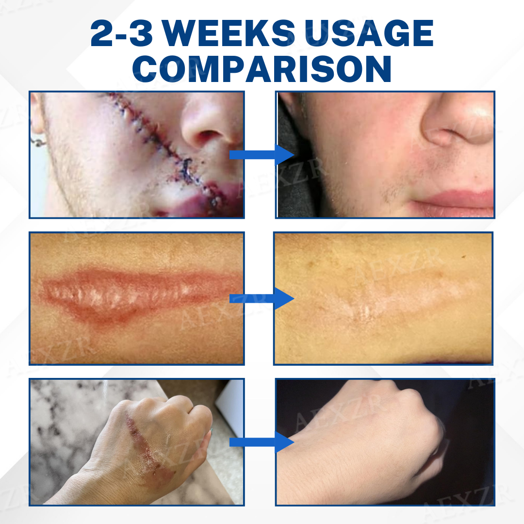 🌿 ScarPhix™ Scar Removal Cream —Clinically Proven to Fade Scars, Restore Smooth Skin