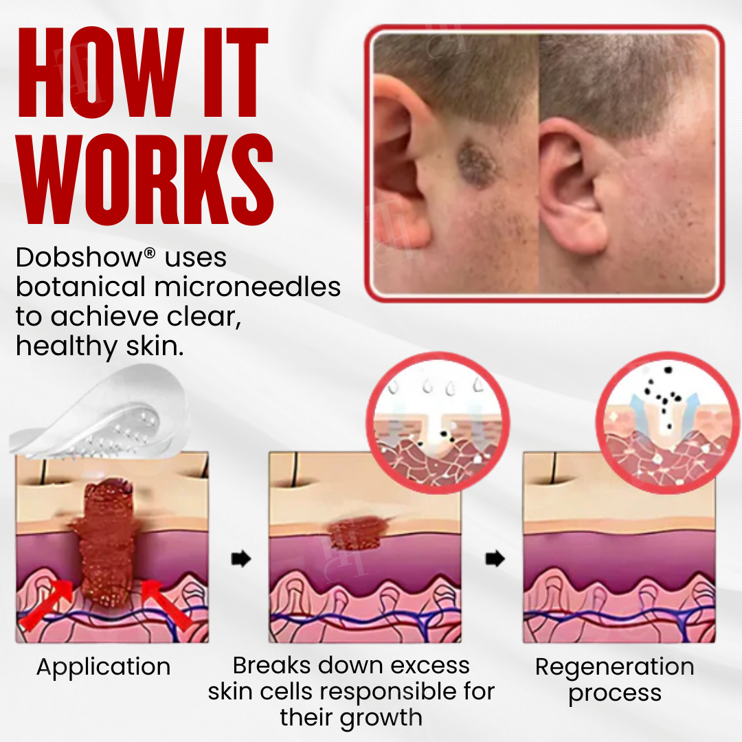 🏆 WartAway Pro — Advanced Microneedle Patches for Painless Wart & Skin Tag Removal – Results in 5 Days! ✨