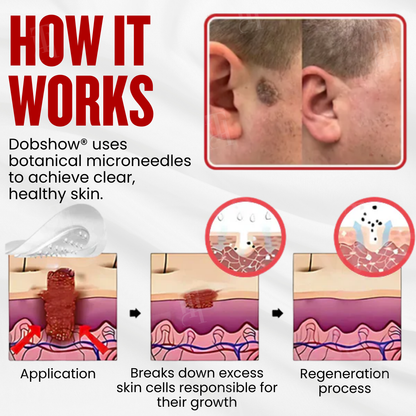 🏆 WartAway Pro — Advanced Microneedle Patches for Painless Wart & Skin Tag Removal – Results in 5 Days! ✨