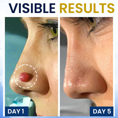 🏆 Advanced Skin Tag & Wart Remover Spray — Freeze Away Unwanted Growths Painlessly at Home! ✨