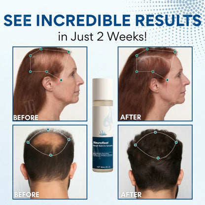 🌱🌿NeuroRoot Reset Roll-On Serum —Wake Up Dormant Follicles in 14 Days, Target Thinning at the Source )